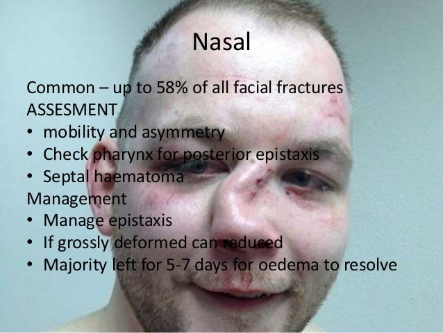 maxillo facial fractures Maxillo facial fractures
